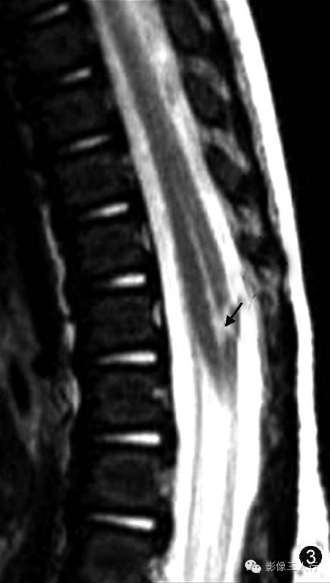 重新正确认识第五脑室的概念及其影像表现