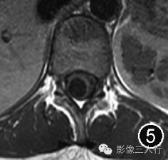 重新正确认识第五脑室的概念及其影像表现
