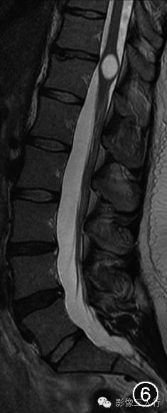 重新正确认识第五脑室的概念及其影像表现
