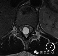 重新正确认识第五脑室的概念及其影像表现
