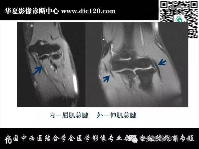 【PPT】肘关节疾病磁共振诊断