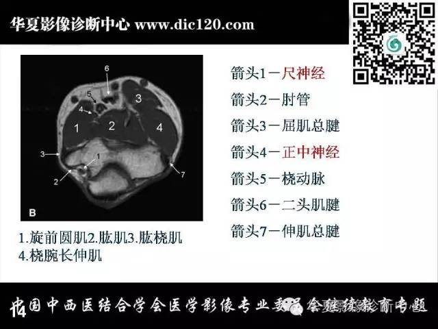 【PPT】肘关节疾病磁共振诊断
