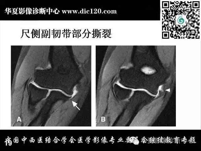 【PPT】肘关节疾病磁共振诊断