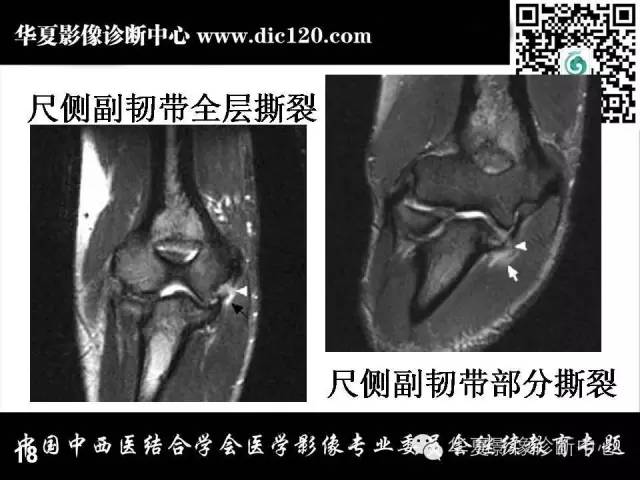 【PPT】肘关节疾病磁共振诊断