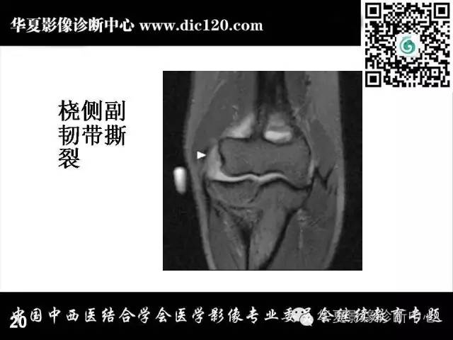 【PPT】肘关节疾病磁共振诊断