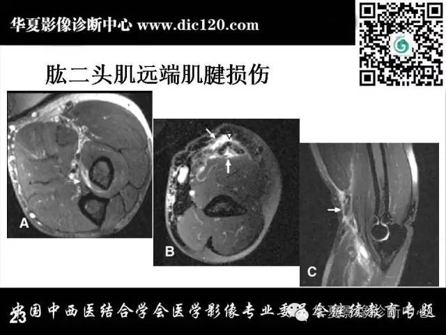 【PPT】肘关节疾病磁共振诊断