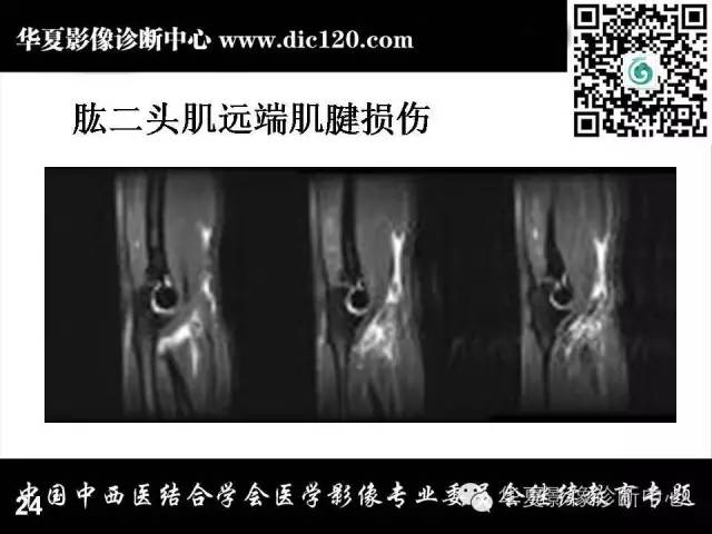 【PPT】肘关节疾病磁共振诊断