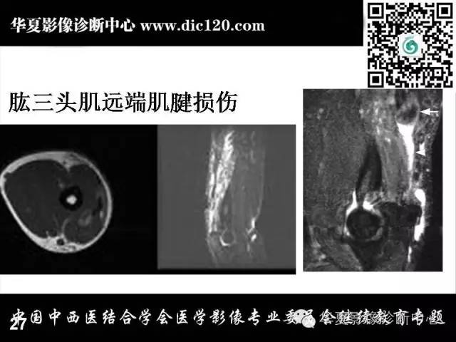 【PPT】肘关节疾病磁共振诊断