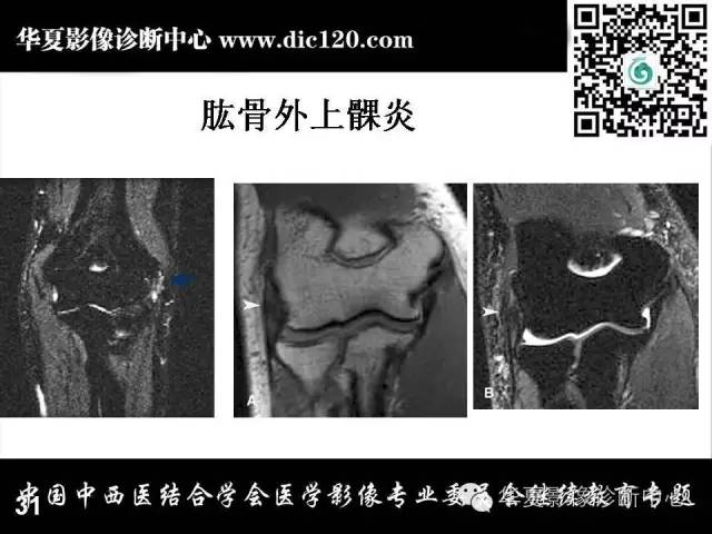 【PPT】肘关节疾病磁共振诊断