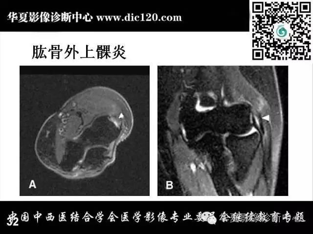 【PPT】肘关节疾病磁共振诊断