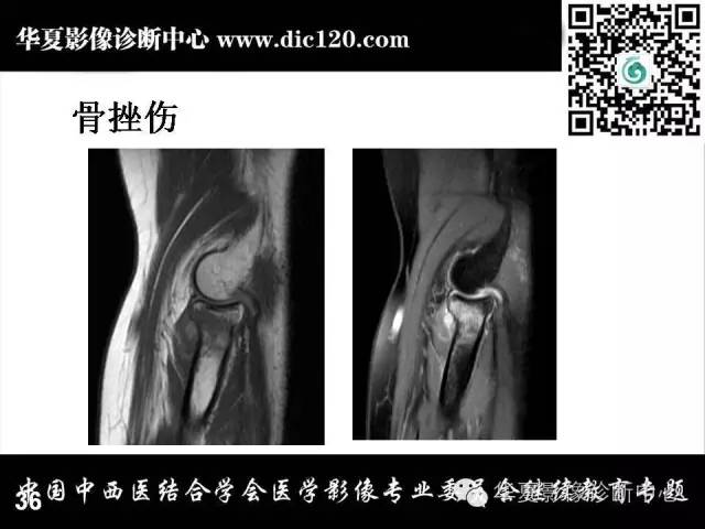 【PPT】肘关节疾病磁共振诊断