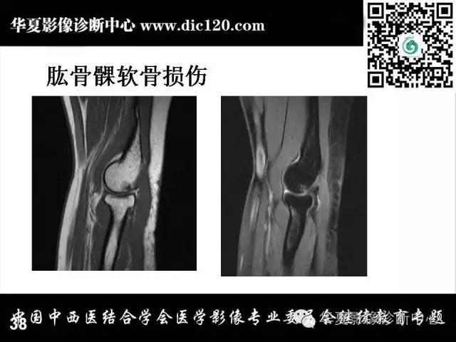 【PPT】肘关节疾病磁共振诊断