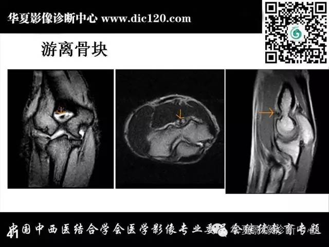 【PPT】肘关节疾病磁共振诊断