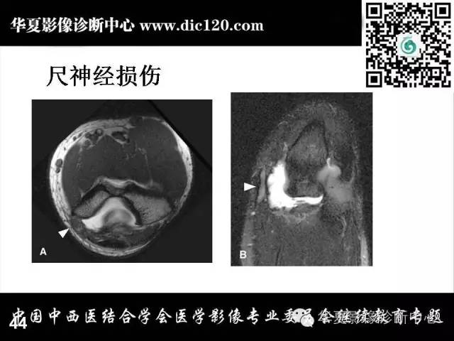 【PPT】肘关节疾病磁共振诊断
