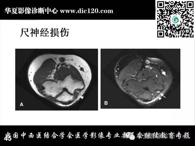 【PPT】肘关节疾病磁共振诊断