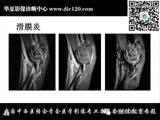 【PPT】肘关节疾病磁共振诊断