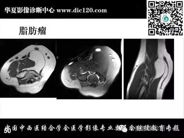 【PPT】肘关节疾病磁共振诊断