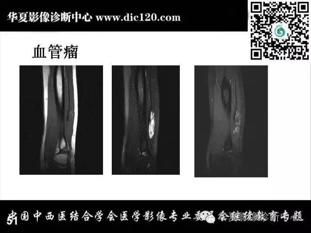 【PPT】肘关节疾病磁共振诊断