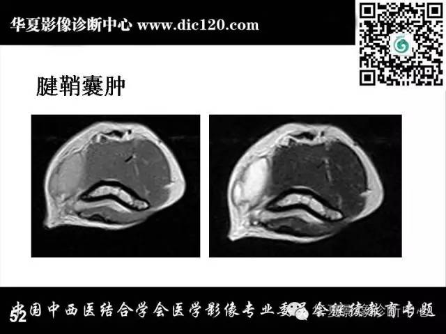 【PPT】肘关节疾病磁共振诊断