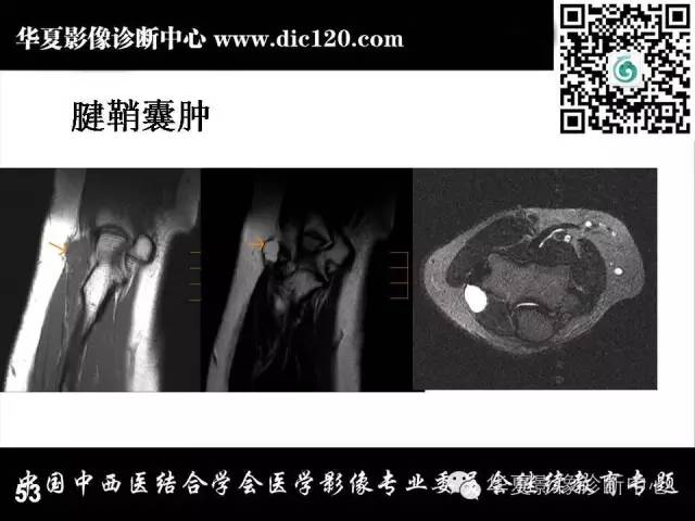 【PPT】肘关节疾病磁共振诊断