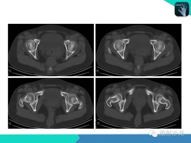 【病例】骶尾部表皮样囊肿1例CT