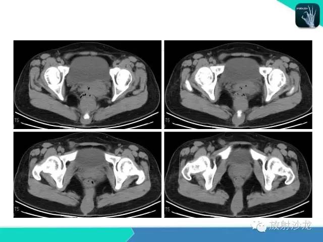 【病例】骶尾部表皮样囊肿1例CT