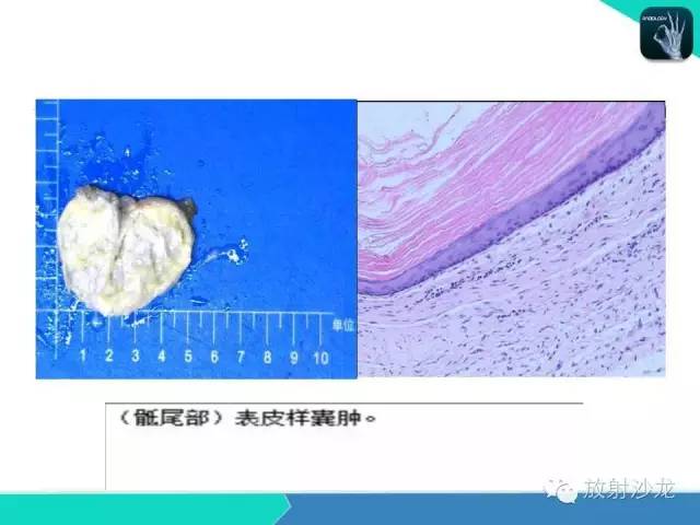 【病例】骶尾部表皮样囊肿1例CT