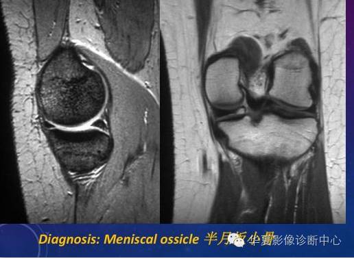 半月板小骨