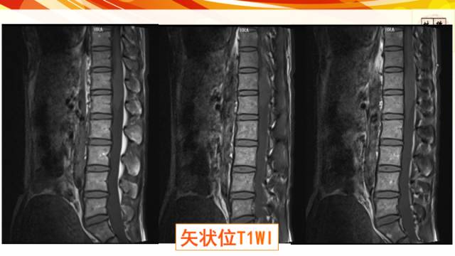 【病例】脊髓胶质母细胞瘤1例MR影像表现与鉴别