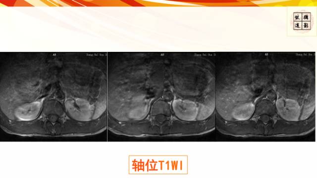 【病例】脊髓胶质母细胞瘤1例MR影像表现与鉴别
