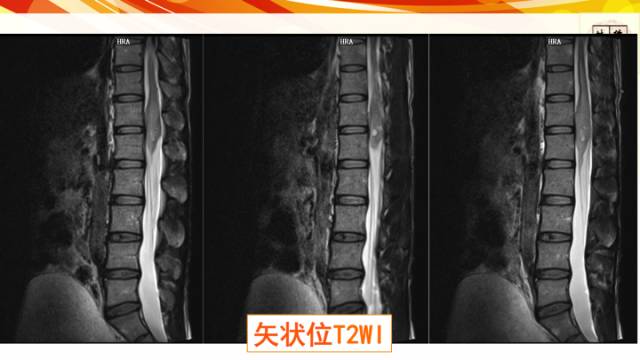 【病例】脊髓胶质母细胞瘤1例MR影像表现与鉴别