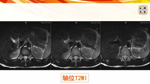 【病例】脊髓胶质母细胞瘤1例MR影像表现与鉴别