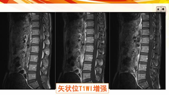 【病例】脊髓胶质母细胞瘤1例MR影像表现与鉴别