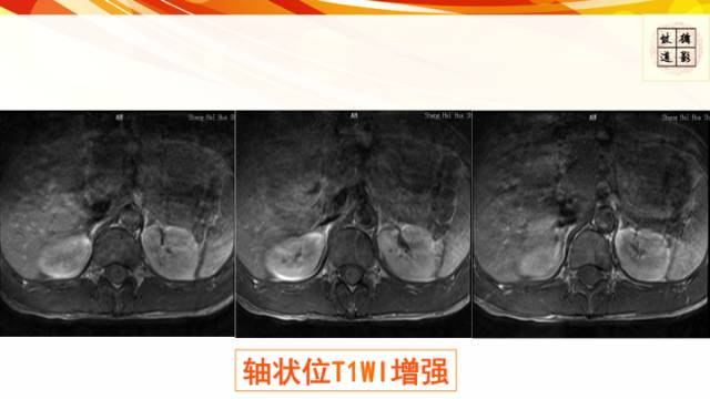 【病例】脊髓胶质母细胞瘤1例MR影像表现与鉴别
