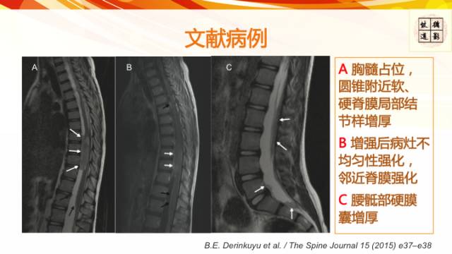 【病例】脊髓胶质母细胞瘤1例MR影像表现与鉴别