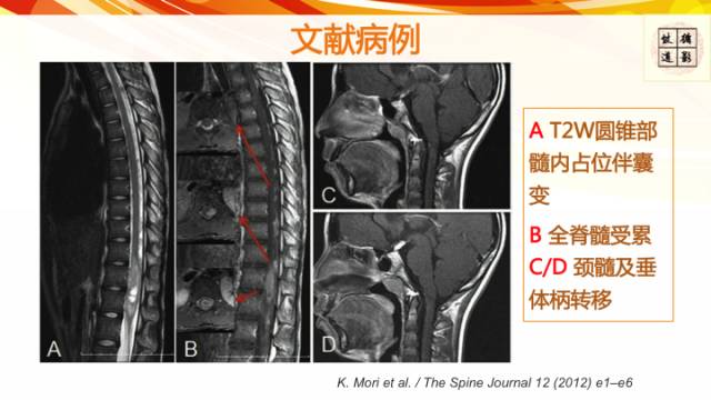 【病例】脊髓胶质母细胞瘤1例MR影像表现与鉴别
