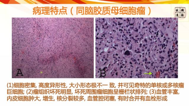【病例】脊髓胶质母细胞瘤1例MR影像表现与鉴别