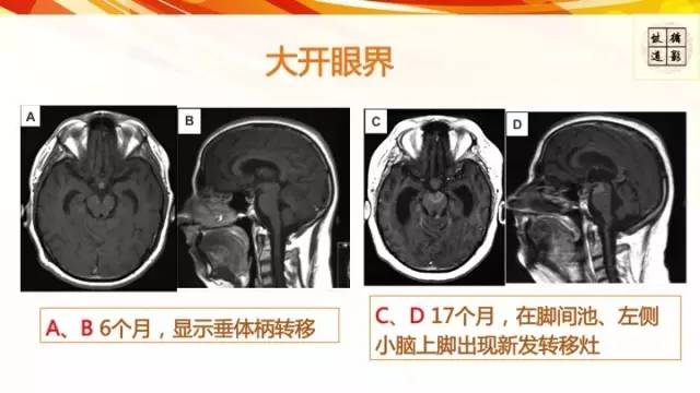 【病例】脊髓胶质母细胞瘤1例MR影像表现与鉴别