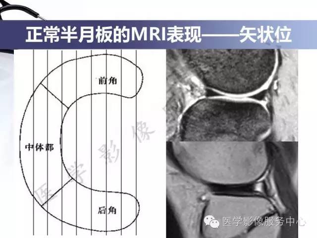 【PPT】半月板病变的MRI诊断