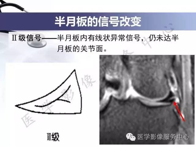 【PPT】半月板病变的MRI诊断