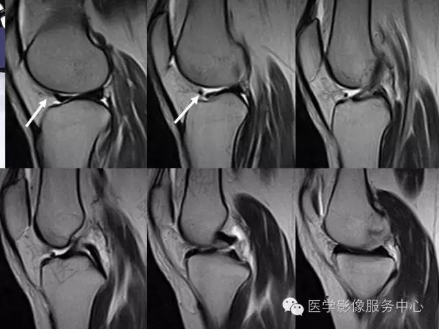 【PPT】半月板病变的MRI诊断