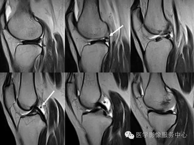 【PPT】半月板病变的MRI诊断