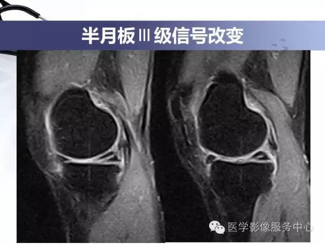【PPT】半月板病变的MRI诊断