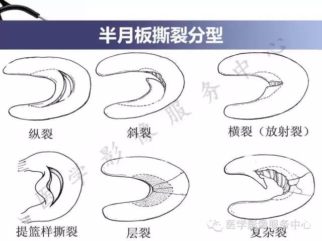 【PPT】半月板病变的MRI诊断