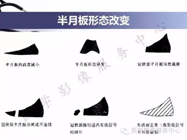 【PPT】半月板病变的MRI诊断
