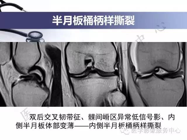 【PPT】半月板病变的MRI诊断