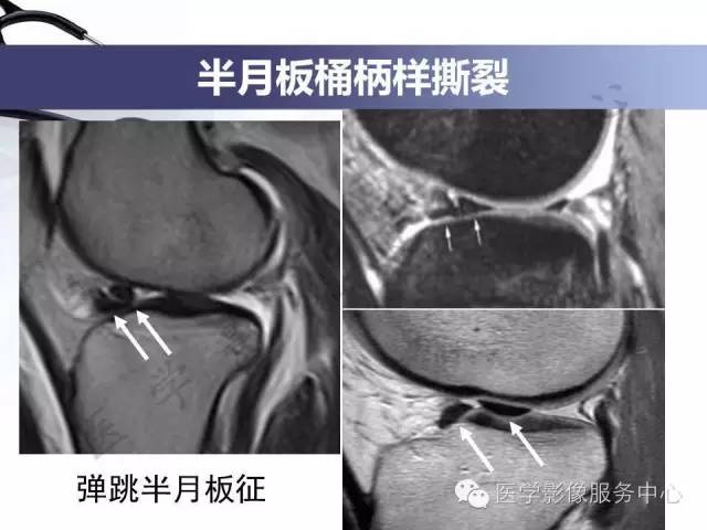 【PPT】半月板病变的MRI诊断