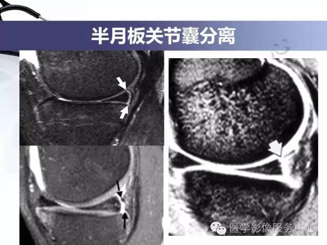 【PPT】半月板病变的MRI诊断