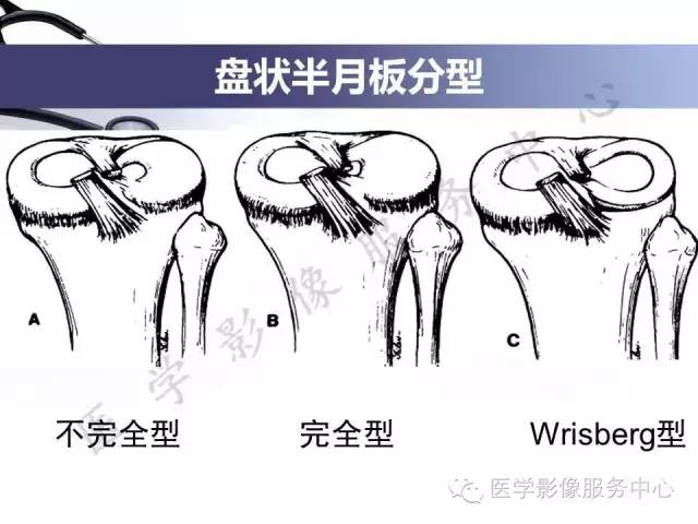 【PPT】半月板病变的MRI诊断