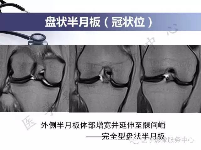 【PPT】半月板病变的MRI诊断